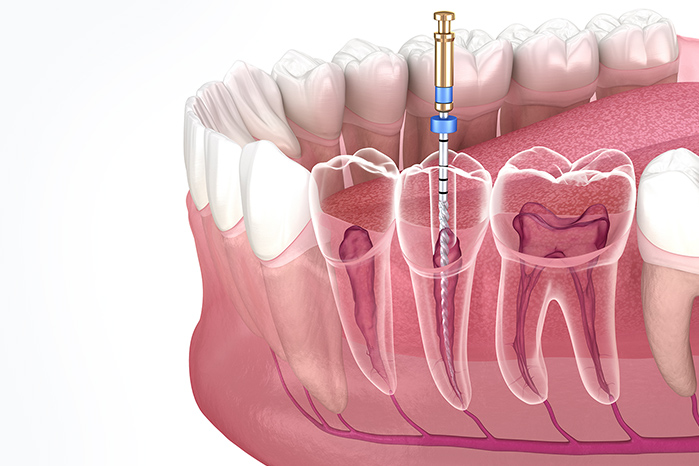 東京大森の歯医者・矯正歯科「大森沢田通り歯科・予防クリニック」｜精密根管治療