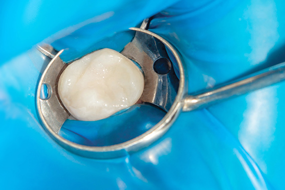 東京大森の歯医者・矯正歯科「大森沢田通り歯科・予防クリニック」｜ラバーダム