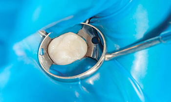 東京大森の歯医者・矯正歯科「大森沢田通り歯科・予防クリニック」｜ラバーダム