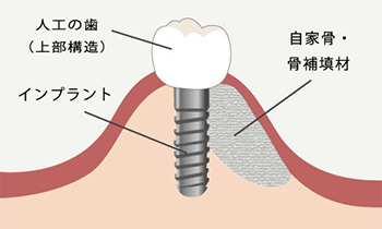 東京大森の歯医者・矯正歯科「大森沢田通り歯科・予防クリニック」｜GBR