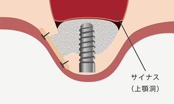 東京大森の歯医者・矯正歯科「大森沢田通り歯科・予防クリニック」｜サイナスリフト