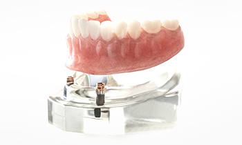 東京大森の歯医者・矯正歯科「大森沢田通り歯科・予防クリニック」｜インプラントオーバデンチャー