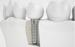 東京大森の歯医者・矯正歯科「大森沢田通り歯科・予防クリニック」｜インプラント