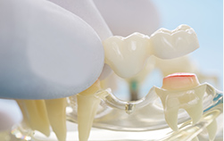 東京大森の歯医者・矯正歯科「大森沢田通り歯科・予防クリニック」｜ブリッジ