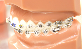 東京大森の歯医者・矯正歯科「大森沢田通り歯科・予防クリニック」｜ワイヤー矯正