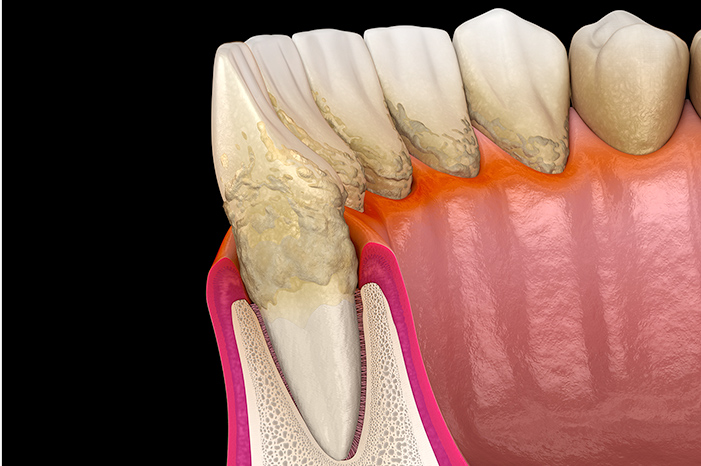 東京大森の歯医者・矯正歯科「大森沢田通り歯科・予防クリニック」｜歯周病治療