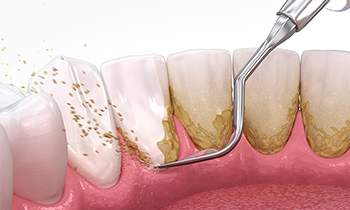 東京大森の歯医者・矯正歯科「大森沢田通り歯科・予防クリニック」｜スケーリング